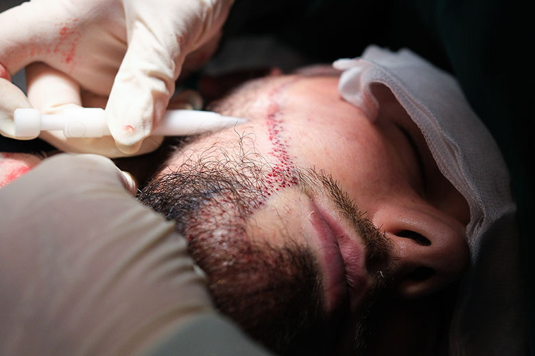Beard Transplants