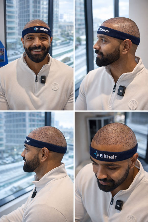 Elithair consultation